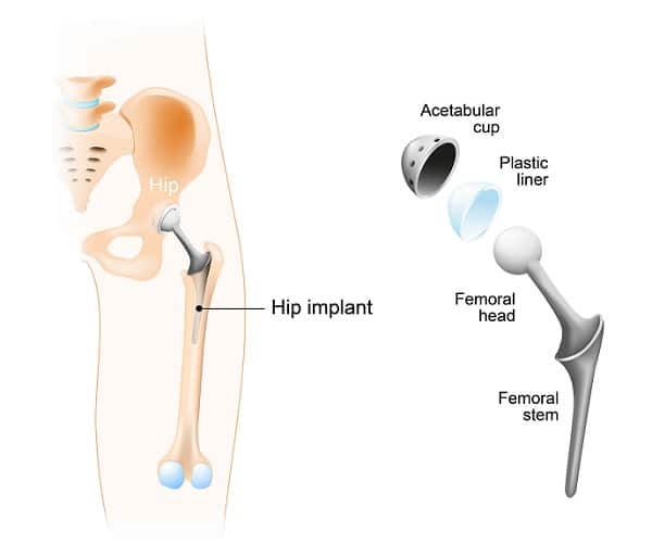 Total Hip Replacement surgery