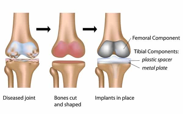 Total Knee Replacement surgery